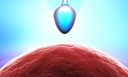 Micro TESE Microsurgical Testicular Sperm