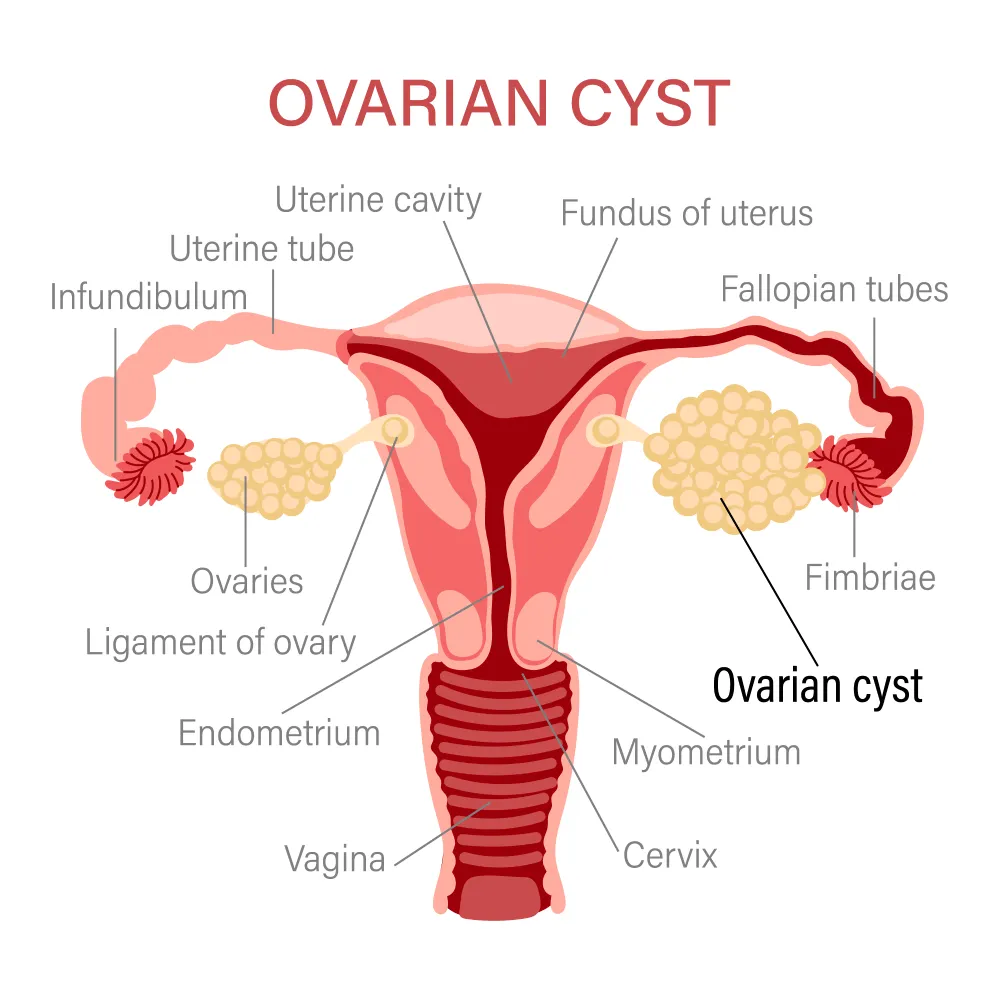 Ovarian Cyst Removal Ovarian Cyst doctor in Delhi NCR